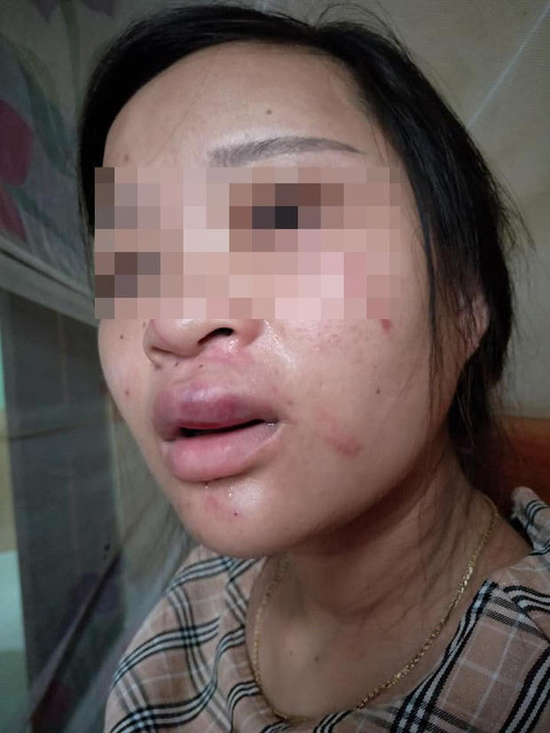 Chồng nghe lời mẹ đánh vợ mang thai tím người vì... đôi giày 135 nghìn đồng?