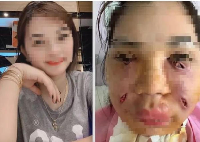 Nữ sinh bị biến dạng khuôn mặt vì làm đẹp bằng bơm mỡ tự thân
