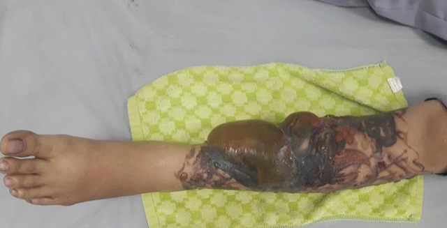 Nam thanh niên nhập viện vì xoá xăm 