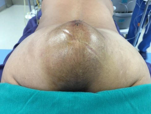 Cắt u khổng lồ cho nam bệnh nhân nằm ngửa suốt 1 năm