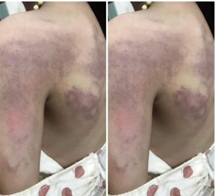 Bé gái lớp 3 bị đánh bầm tím người, tạm đình chỉ công tác cô giáo