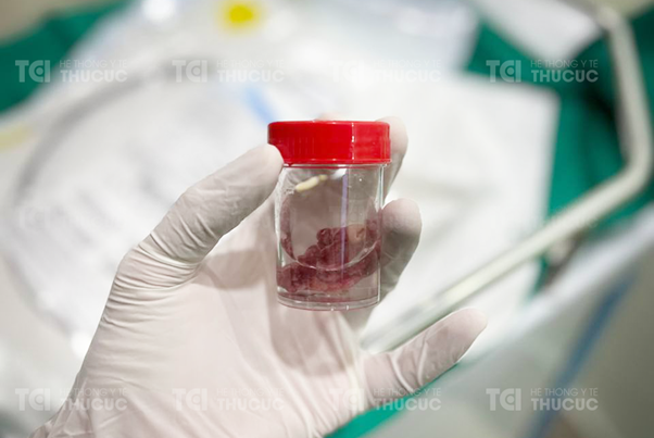 Chàng trai 25 tuổi đã phải mang khối polyp đại tràng khổng lồ