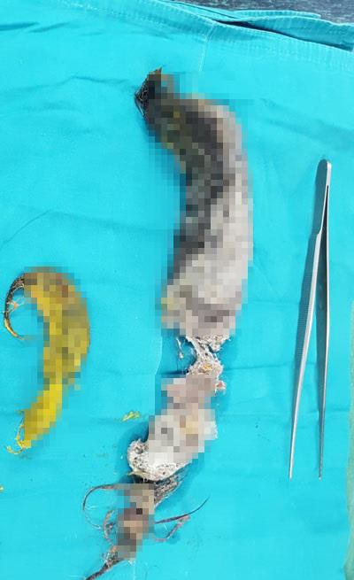 Hy hữu bé gái 5 tuổi suýt mất mạng vì thói quen ăn tóc