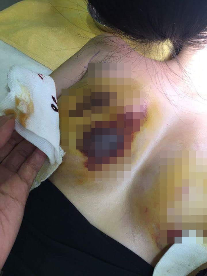 Thanh tra Sở Y tế vào cuộc vụ biến chứng nâng ngực tại BV Kim Cương