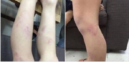 Hà Nội: Tạm đình chỉ giáo viên đánh tím chân học sinh lớp 2