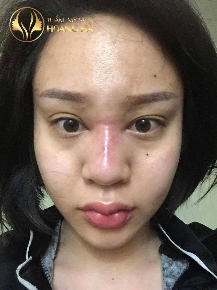 Quá trình “chiến đấu” với Silicone công nghiệp