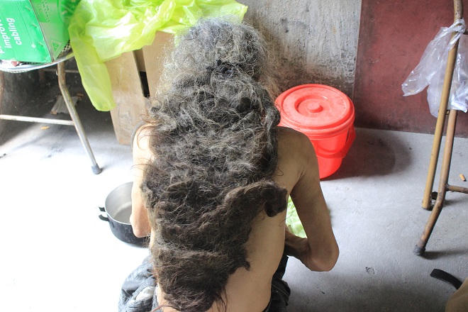 Người đàn ông hơn 10 năm không dám gội đầu, soi gương vì mái tóc “quái dị”