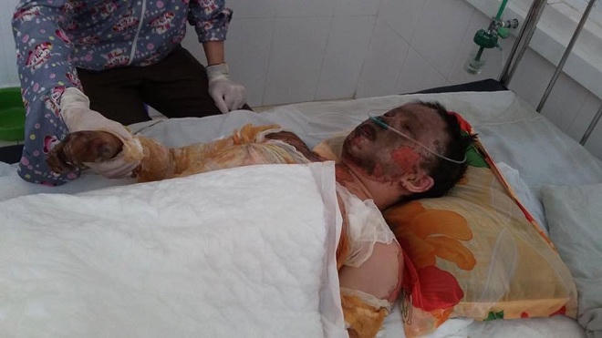 Thiếu nữ xinh đẹp từng giờ giành giật sự sống vì bỏng xăng