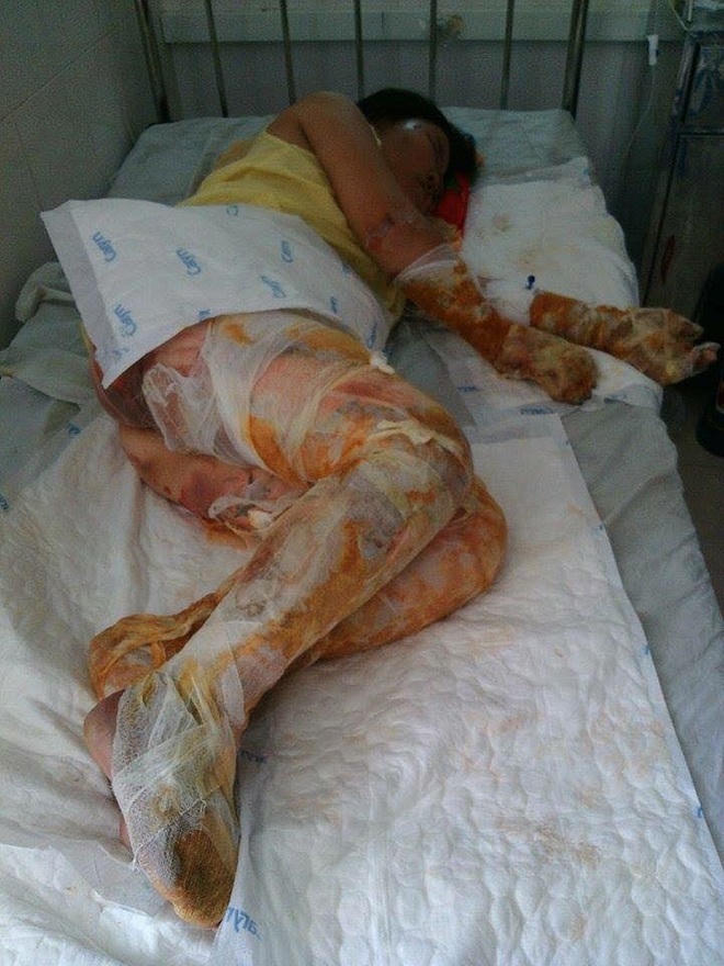 Thiếu nữ xinh đẹp từng giờ giành giật sự sống vì bỏng xăng