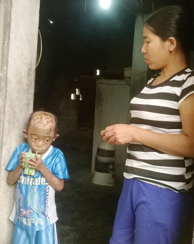 Hai đứa trẻ mắc bệnh lạ toàn thân chằng chịt lớp da sưng mủ