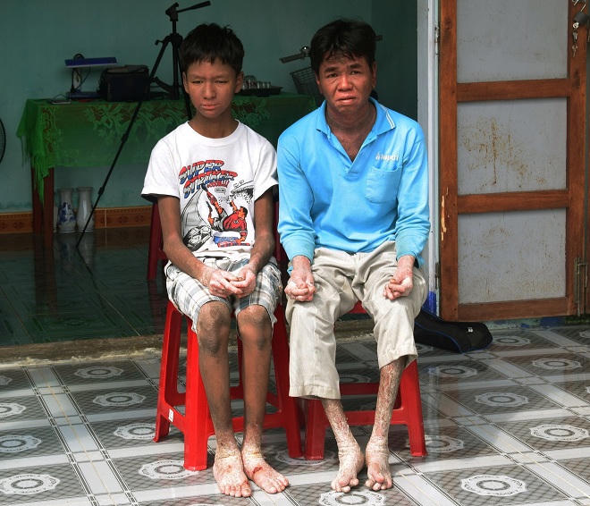 "Người rắn" và ước mơ họa sĩ