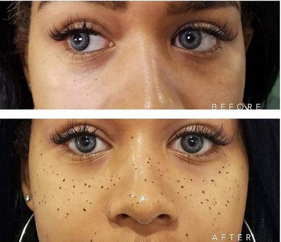 Xăm tàn nhang- xu hướng làm đẹp mới trên thế giới