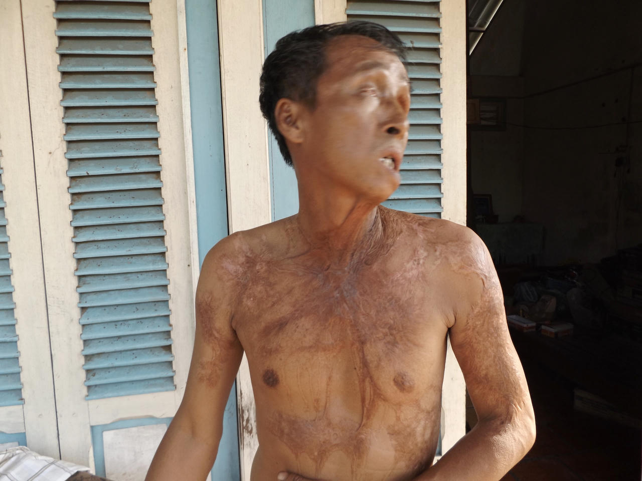 Người đàn bà trốn nã 24 năm sau ngày 'ngứa ghẻ'  tạt axit ông hàng xóm