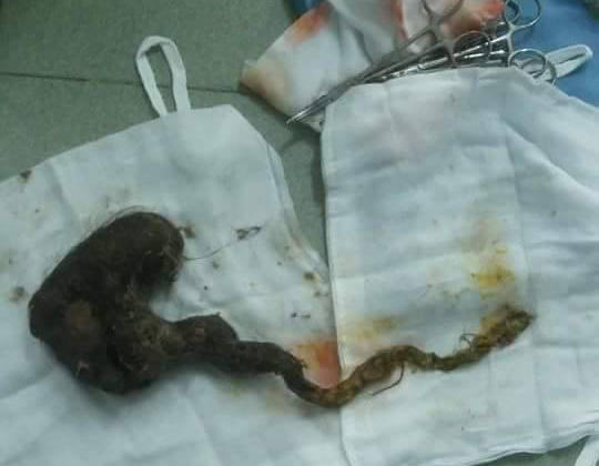 Cô bé 6 tuổi “nghiện” ăn tóc đến suy kiệt cơ thể