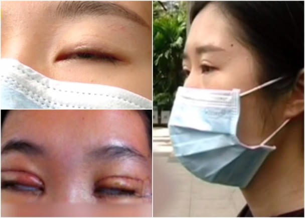 Biến chứng hãi hùng sau thẩm mỹ