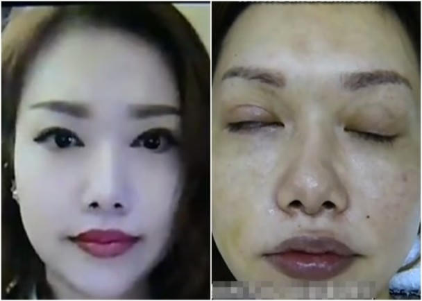 Biến chứng hãi hùng sau thẩm mỹ