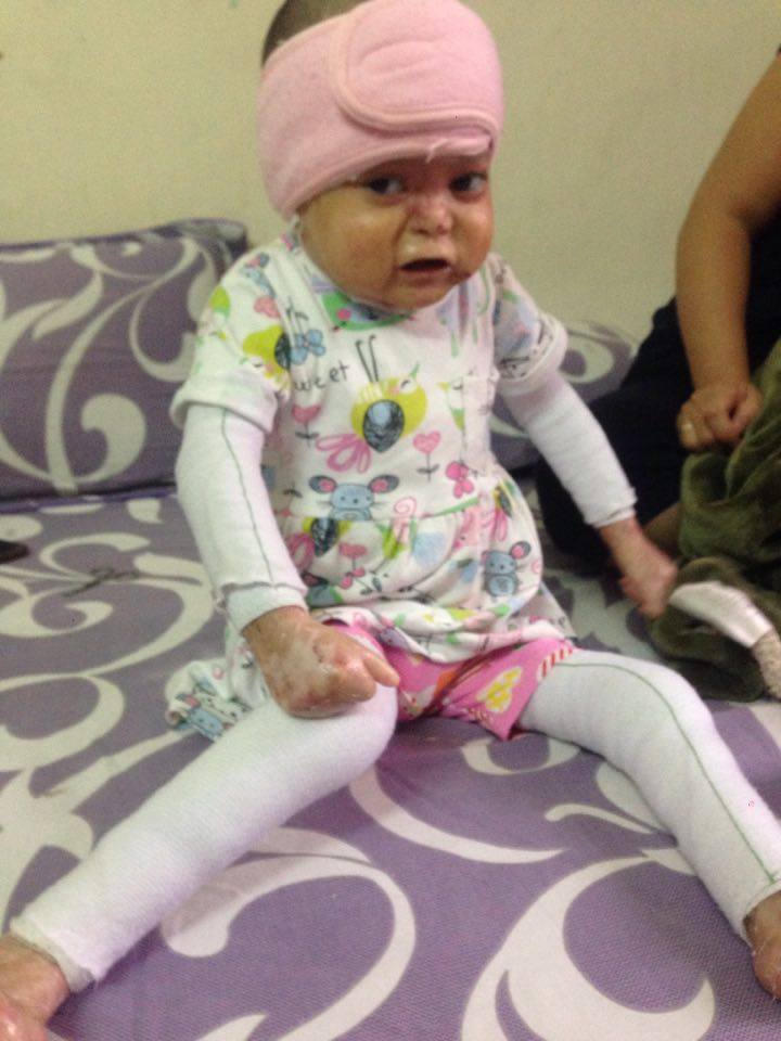 Bé gái 5 tuổi toàn thân bong tróc mong chờ một phép màu