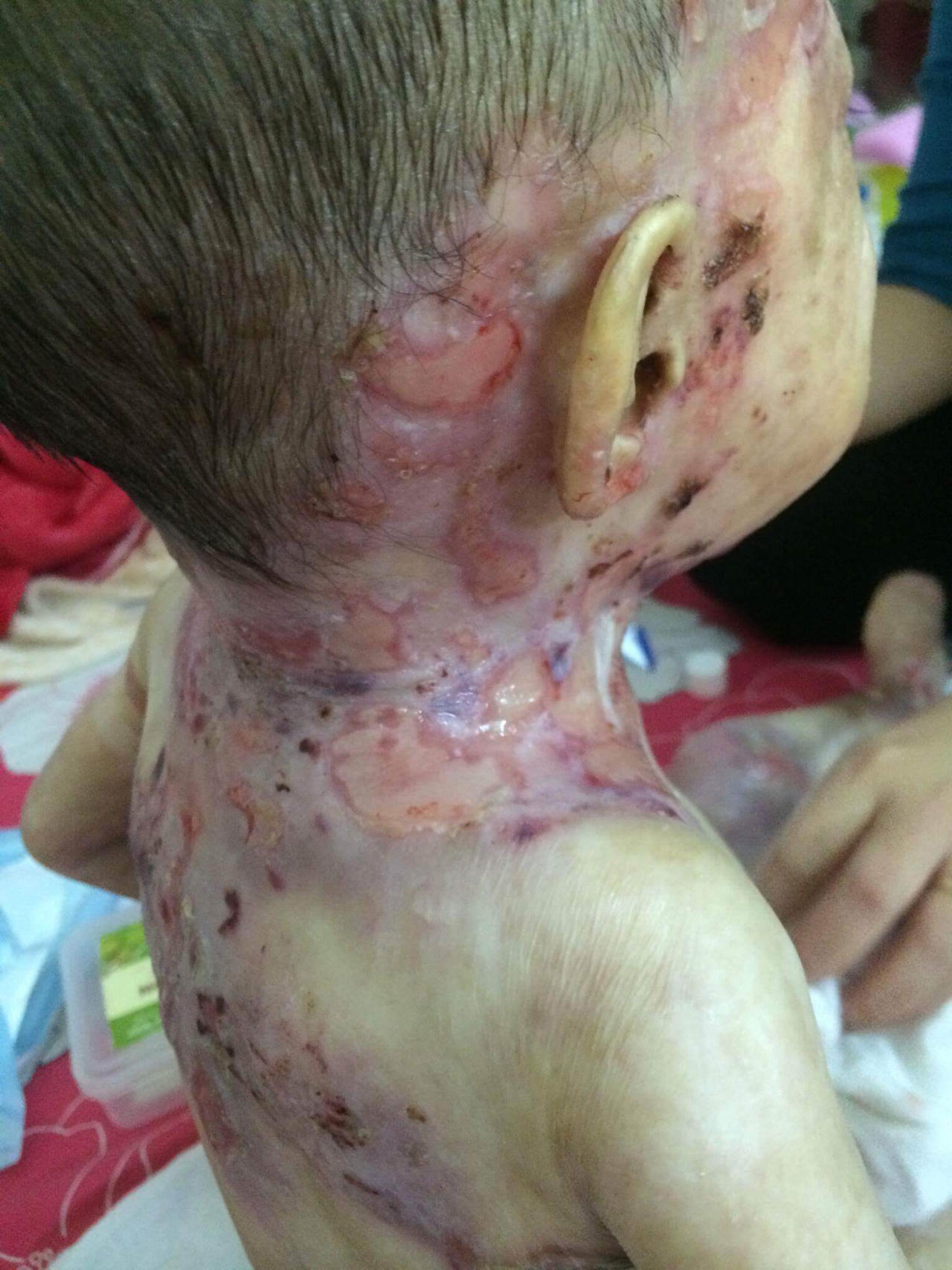 Bé gái 5 tuổi toàn thân bong tróc mong chờ một phép màu