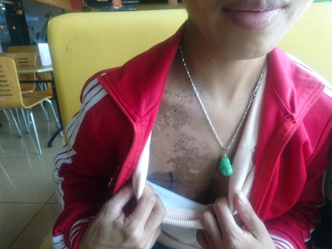 Ngày ăn cơm từ thiện, tối ngủ gầm cầu thang chiến đấu với bệnh ung thư vú