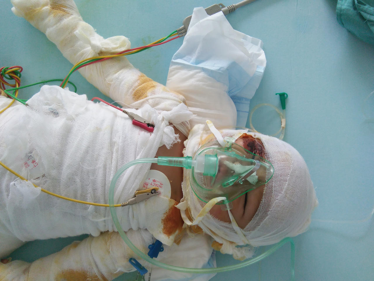 Ngã vào bếp lửa, bé gái 7 tháng tuổi người Mông chờ mong một phép màu