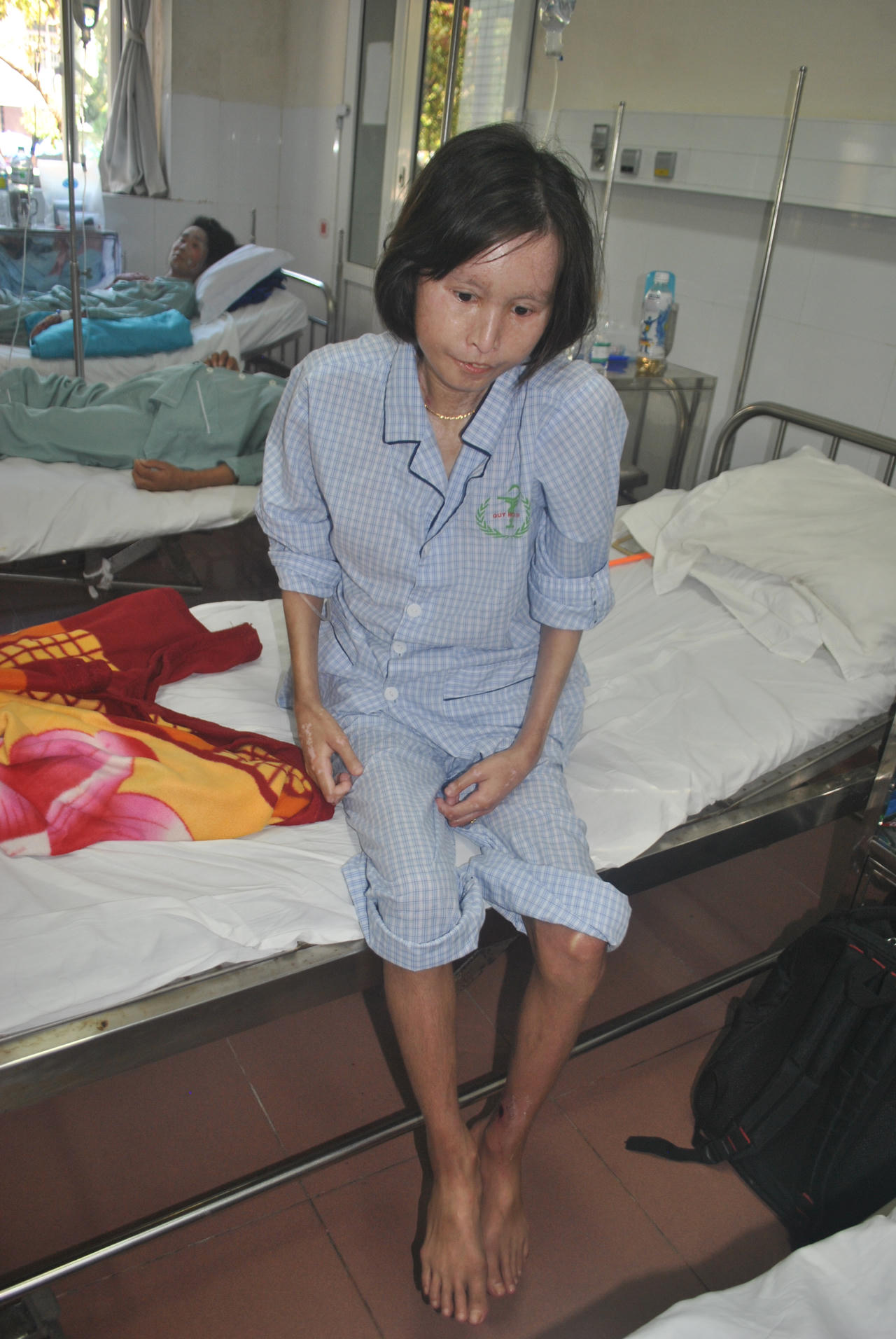 Hãi hùng căn bệnh xơ cứng bì toàn thể