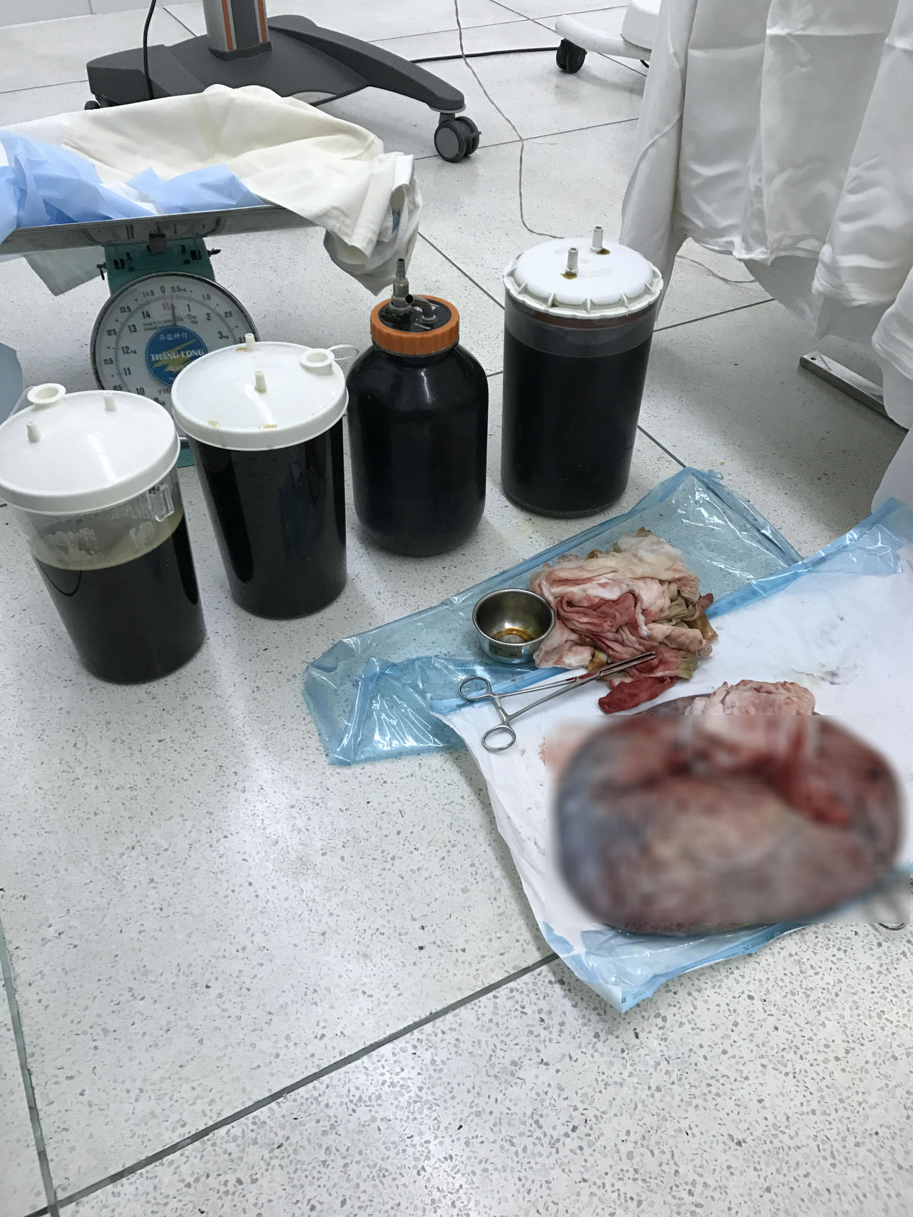 Sóc Trăng: Phẫu thuật thành công người đàn bà mang khối u buồng trứng nặng 20 kg 