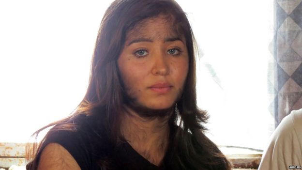 Kỳ lạ một gia đình mắc hội chứng “người sói”