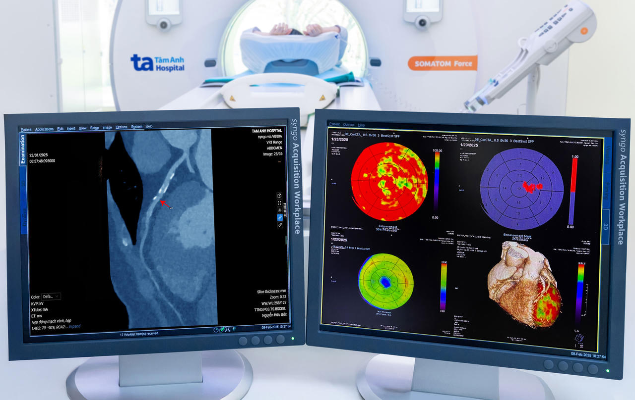 Siêu máy chụp CT phát hiện sớm đột quỵ, ung thư tạng