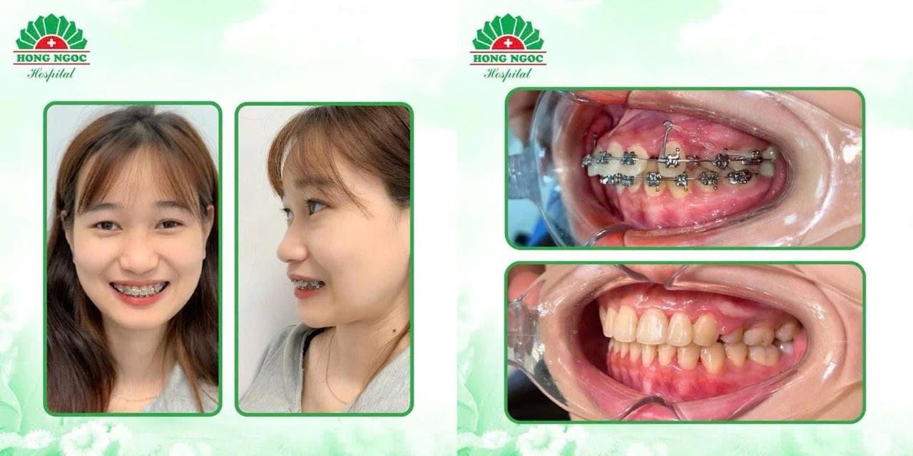 Cảnh báo: Niềng răng hỏng vì những lý do không ngờ