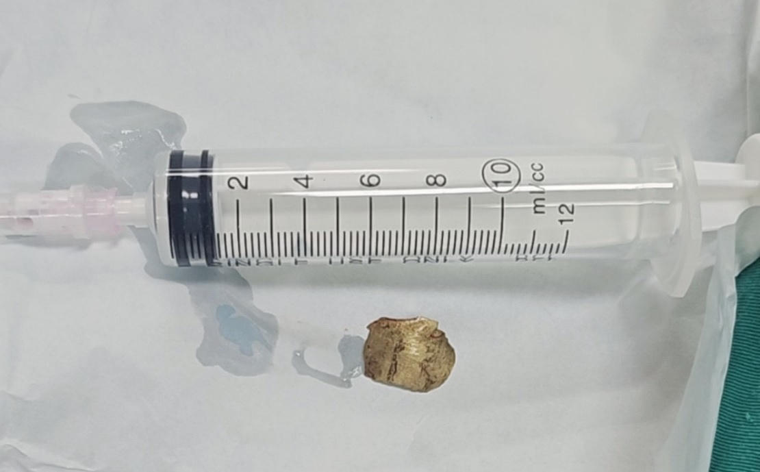 Cứu sống người đàn ông bị mảnh đạn văng trúng cổ lúc làm vườn