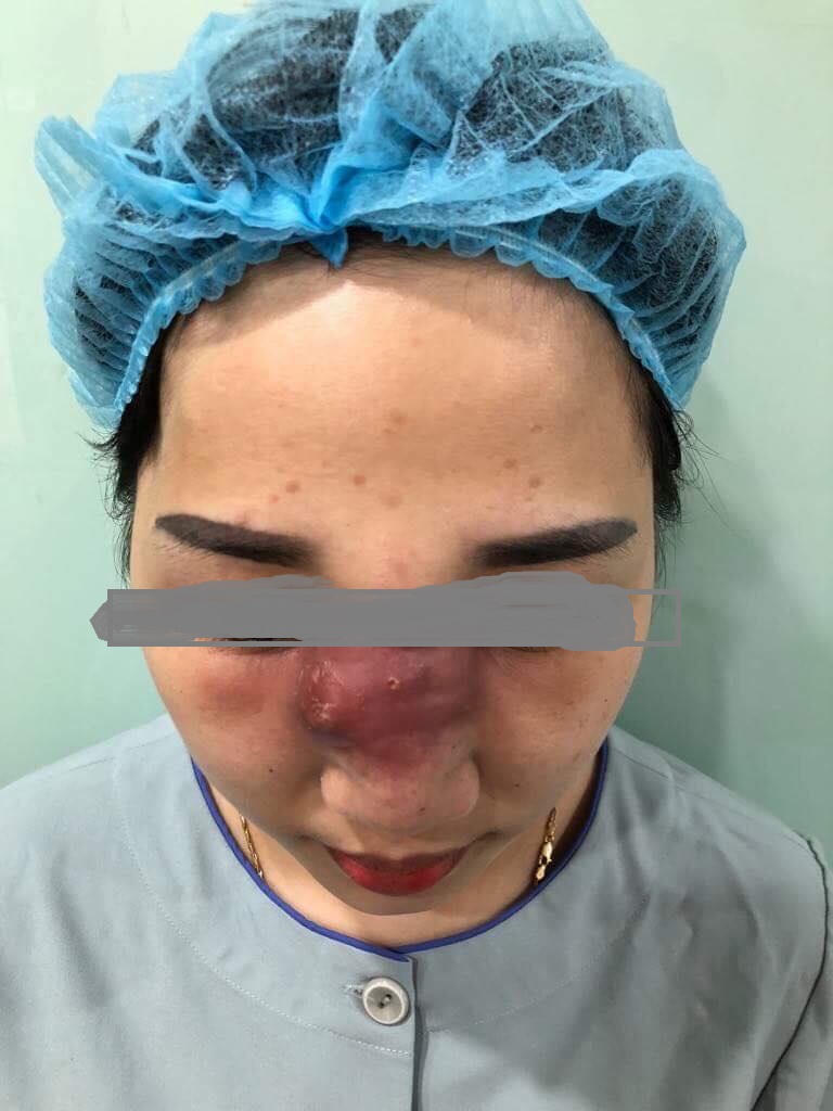 Nguy cơ hoại tử mũi vì tiêm filler tại spa