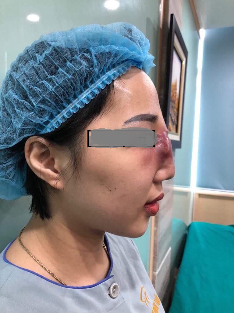 Nguy cơ hoại tử mũi vì tiêm filler tại spa