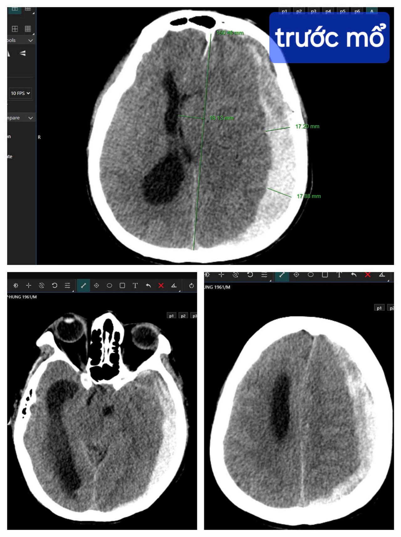 Giành lại sự sống cho bệnh nhân từ tay ‘tử thần’