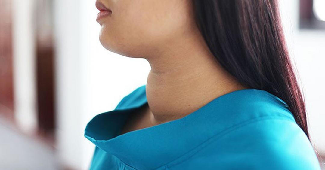 Ích Giáp Vương - Giải pháp vàng cho người bị bướu cổ