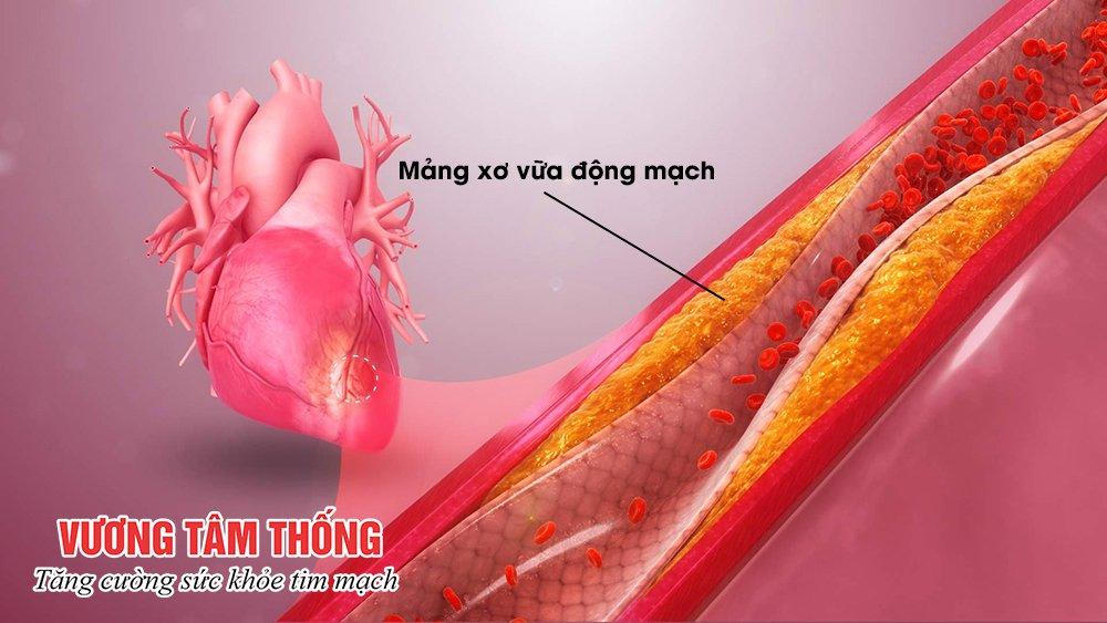 Bệnh mạch vành (thiếu máu cơ tim): Dấu hiệu nhận biết và cách trị hiệu quả