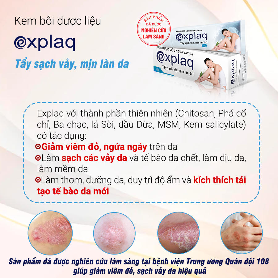 Bệnh vảy phấn trắng và cách cải thiện triệu chứng hiệu quả nhờ kem bôi Explaq