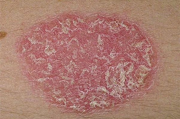 Bệnh vảy phấn trắng và cách cải thiện triệu chứng hiệu quả nhờ kem bôi Explaq