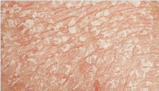 Bệnh vảy phấn trắng và cách cải thiện triệu chứng hiệu quả nhờ kem bôi Explaq