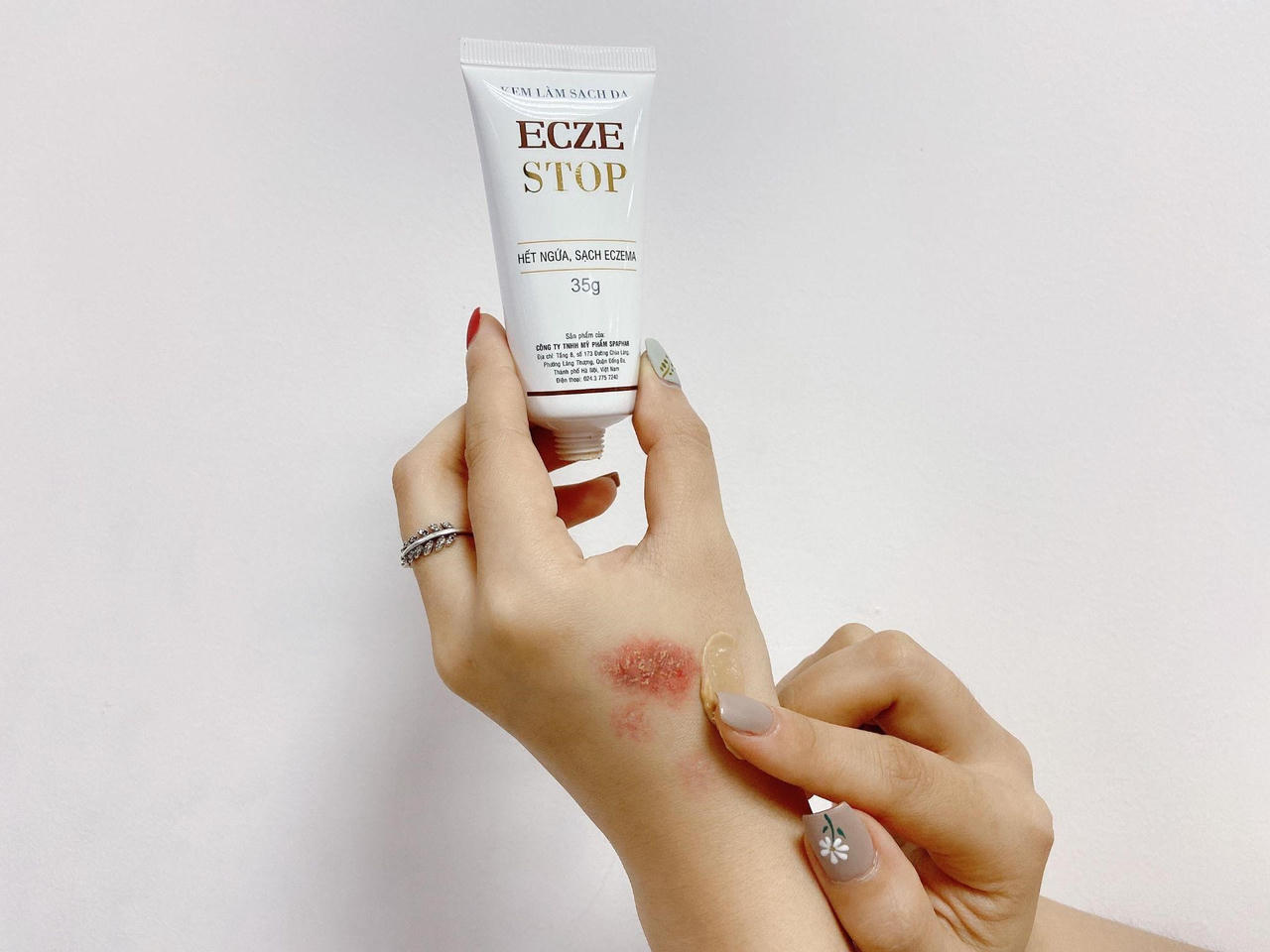 Tìm hiểu về bệnh viêm da tiếp xúc và giải pháp toàn diện từ Eczestop