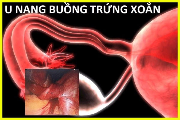 Cẩn trọng với 5 biến chứng của u nang buồng trứng và giải pháp cải thiện từ Nga Phụ Khang
