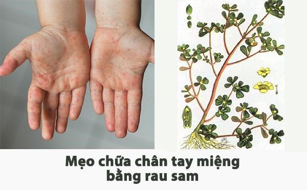 Mẹo chữa chân tay miệng và giải pháp từ gel Subạc