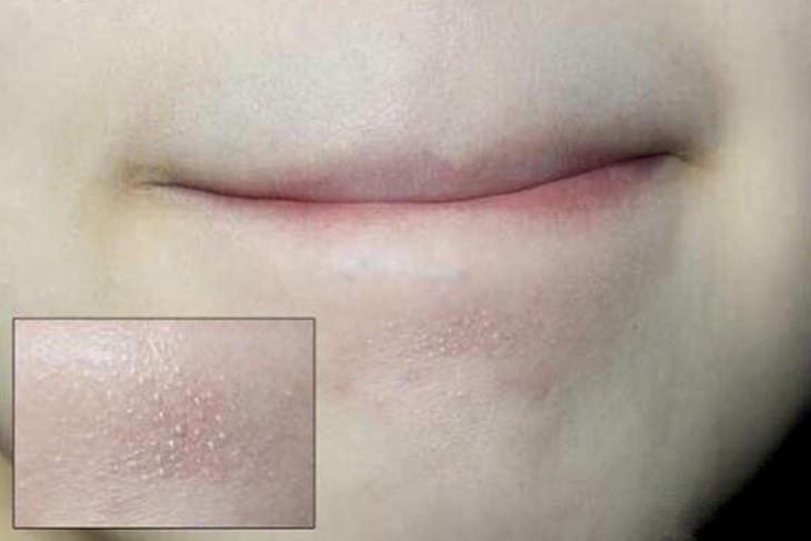 Các cách giảm mụn cám tại nhà và giải pháp từ Azacné