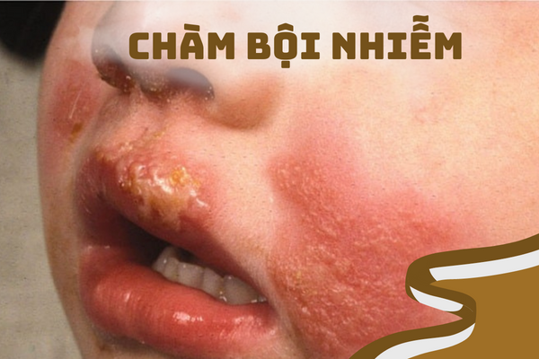 Chàm bội nhiễm và cách cải thiện bệnh từ kem bôi Eczestop 