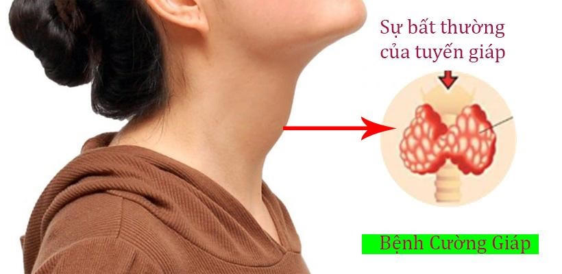 7 nguyên nhân u tuyến giáp và giải pháp từ Ích Giáp Vương