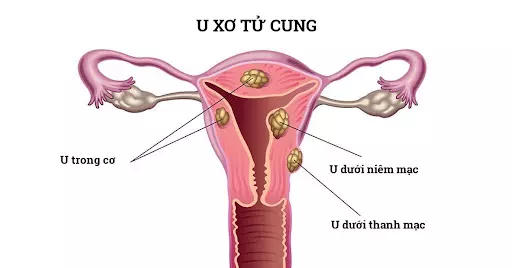 Nga Phụ Khang - Giải pháp hỗ trợ đẩy lùi u xơ tử cung hiệu quả