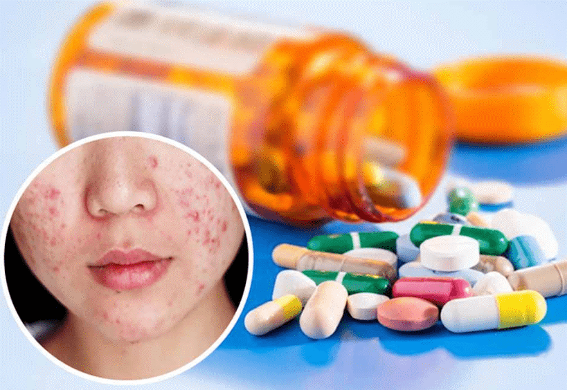 Tìm hiểu về mụn trứng cá bọc và phương pháp cải thiện nhờ kem thảo dược Azacné