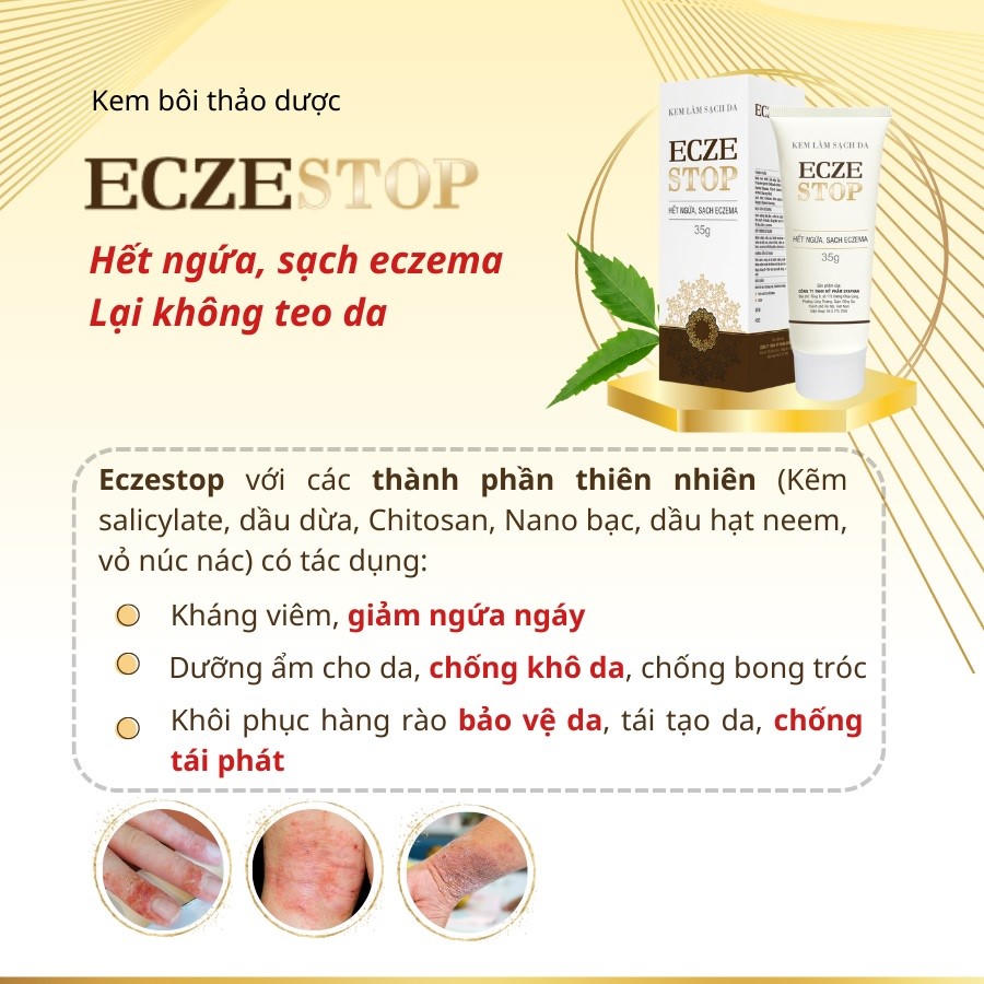 Viêm da cơ địa và cách cải thiện hiệu quả nhờ kem bôi Eczestop 