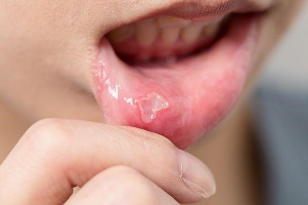 Viêm loét miệng gây đau rát, khó chịu - Hãy dùng gel bôi Gumimouth