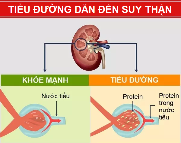 Top 5+ nguyên nhân suy thận và cách hỗ trợ kiểm soát nhờ Ích Thận Vương