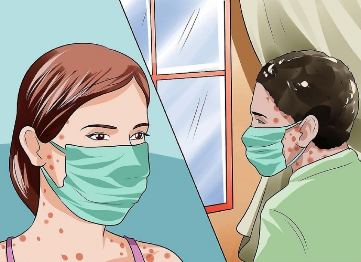 Bệnh thủy đậu lây qua đường nào? Cách giúp bệnh nhanh cải thiện nhờ bộ đôi Subạc